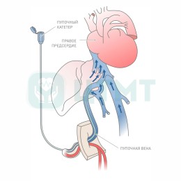 Катетер пупочный 6 Ch\Fr, 500 мм