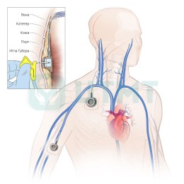 Набор для имплантации подкожной венозной порт-системы, титан, 6 Fr, Low Profile, REF - 0205-MVLPT-06