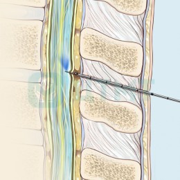 Набор для спинально-эпидуральной анестезии: Игла Tuohy Turn-Lock, 18G, Игла Quincke 27G
