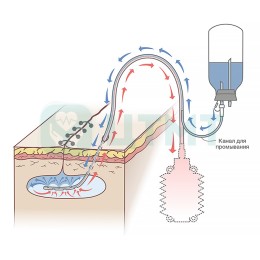 Одноразовая двухпросветная трубка, ПВХ, 30 Fr, длина 500 мм