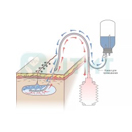 Одноразовая двухпросветная трубка, ПВХ, 36 Fr, длина 500 мм