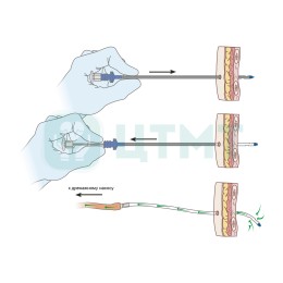 Торакальный троакар катетер ПВХ со стилетом, 16 Fr, длина 25 см